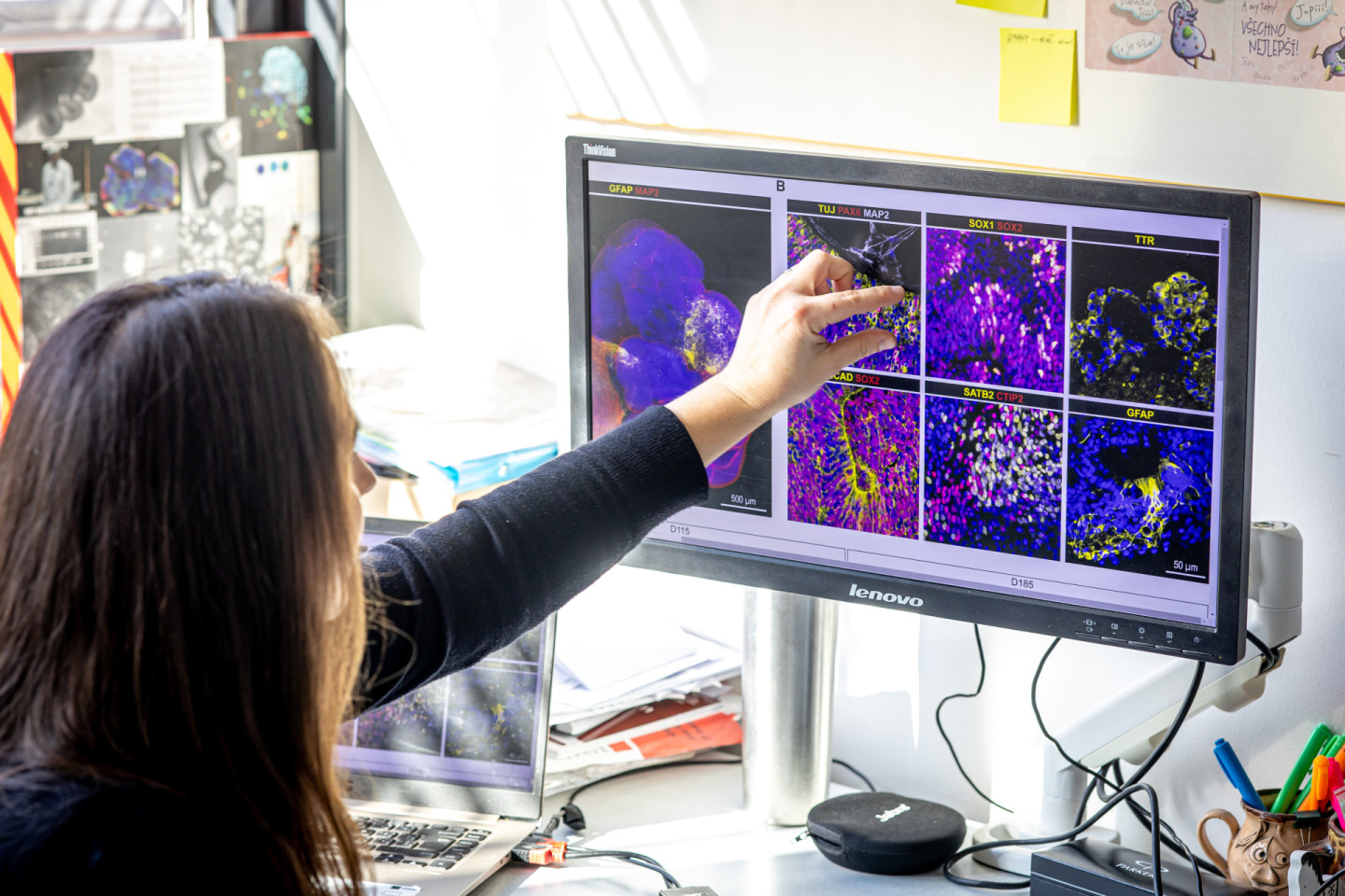 Vědkyně, která studuje Alzheimerovu nemoc s pomocí „minimozků“ vytvořených ve zkumavce